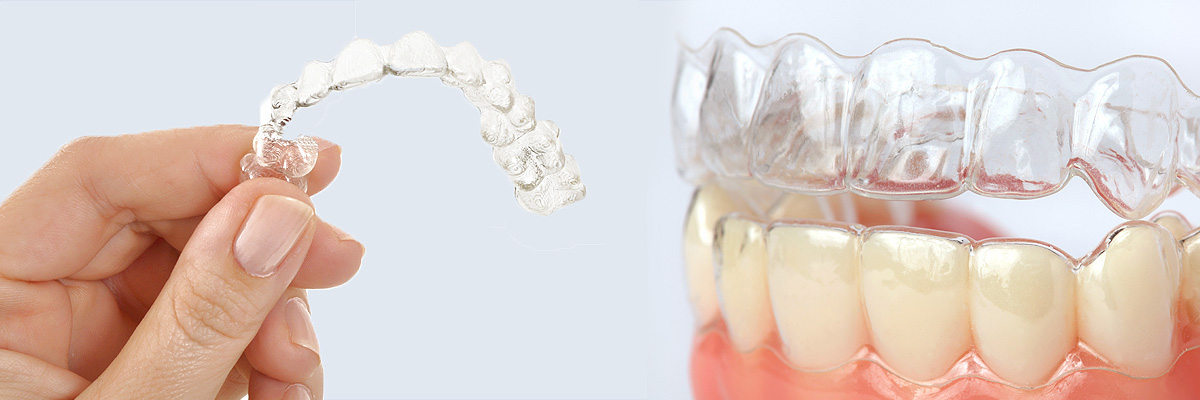 Huntsville Alternative to Braces for Teens