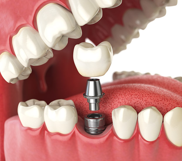 Huntsville Will I Need a Bone Graft for Dental Implants