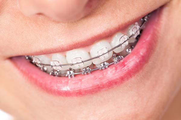 Clear Braces from a General Dentist - Smiles by Design, PC Huntsville  Alabama