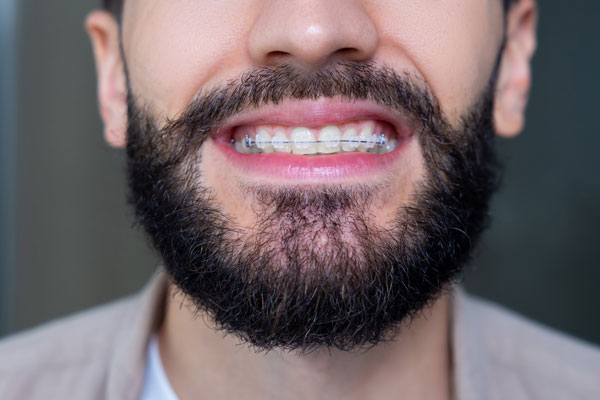 How To Maintain Your Oral Health With Clear Braces From A General Dentist