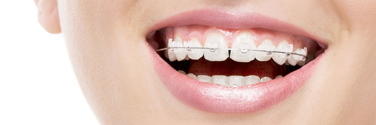 Huntsville Invisible Orthodontics