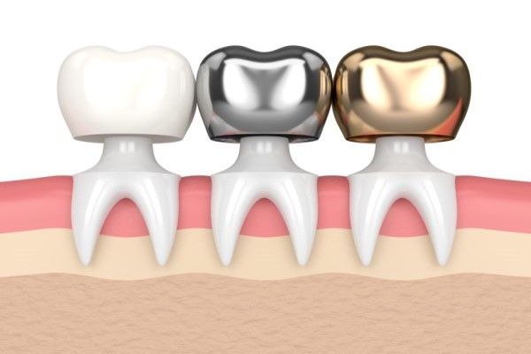 What Role Do Dental Crowns Play In Your Oral Health?