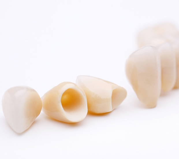 Huntsville Dental Crowns and Dental Bridges