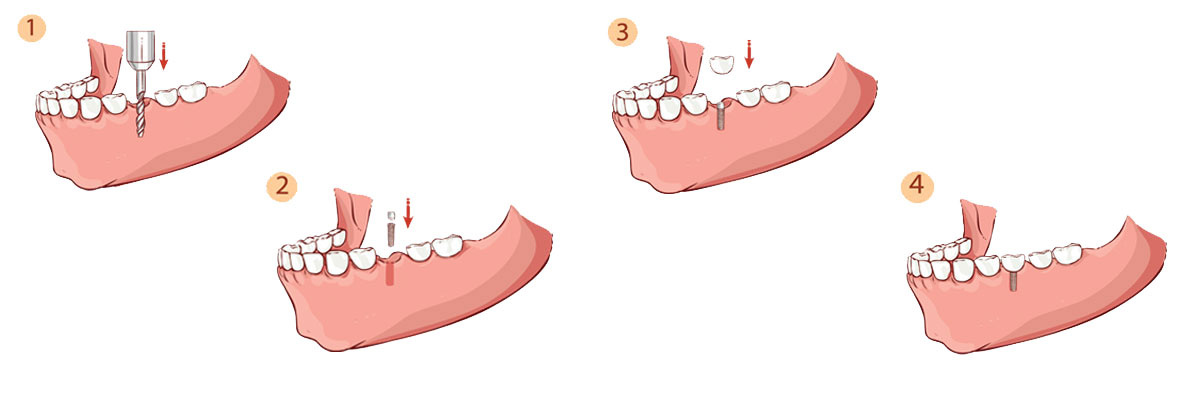 Huntsville The Dental Implant Procedure