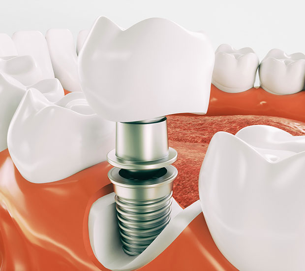 Huntsville Dental Implant Restoration