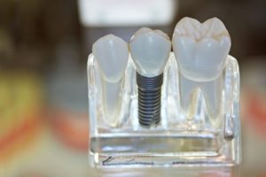 Why You Should Consider Implant Dentistry