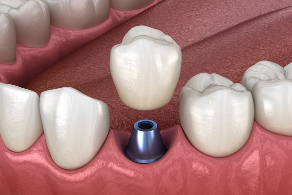Tips For Implant Crown Care