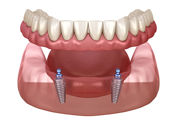 Implant Overdenture Options for Replacing Missing Teeth from Smiles by Design, PC in Huntsville, AL