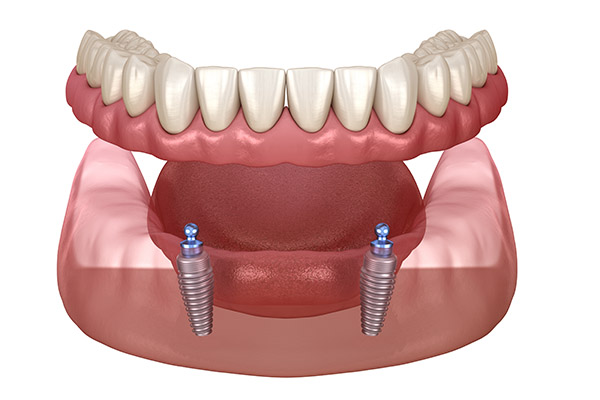 Implant Overdentures: A Solution for Missing Teeth