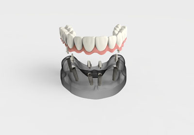 Implant-Supported Dentures