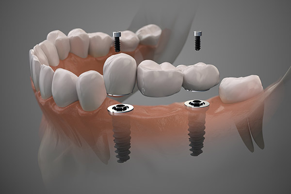 Implant Supported Full Bridge - An Option for Replacing Missing Teeth from Smiles by Design, PC in Huntsville, AL