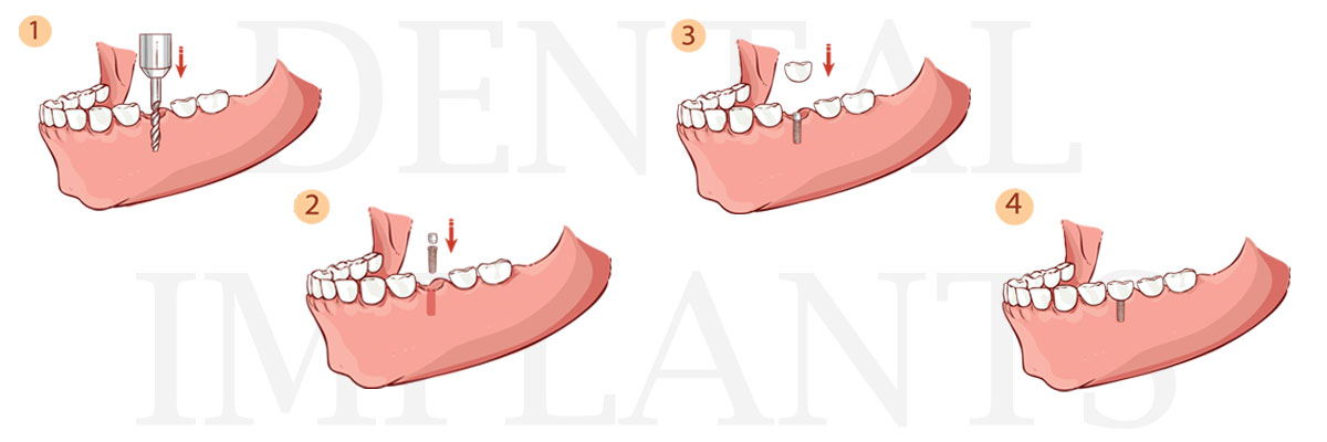 Huntsville The Difference Between Dental Implants and Mini Dental Implants