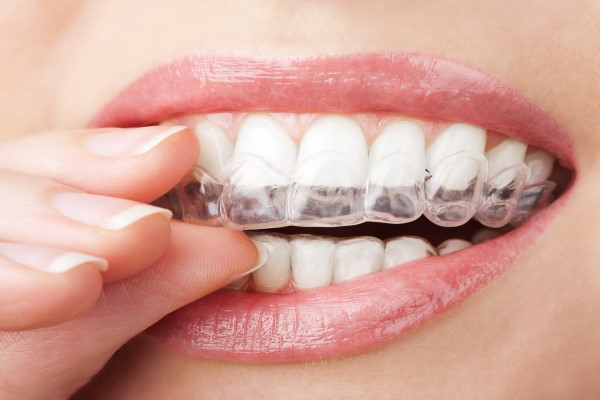 Are Invisible Braces Right For Everyone?