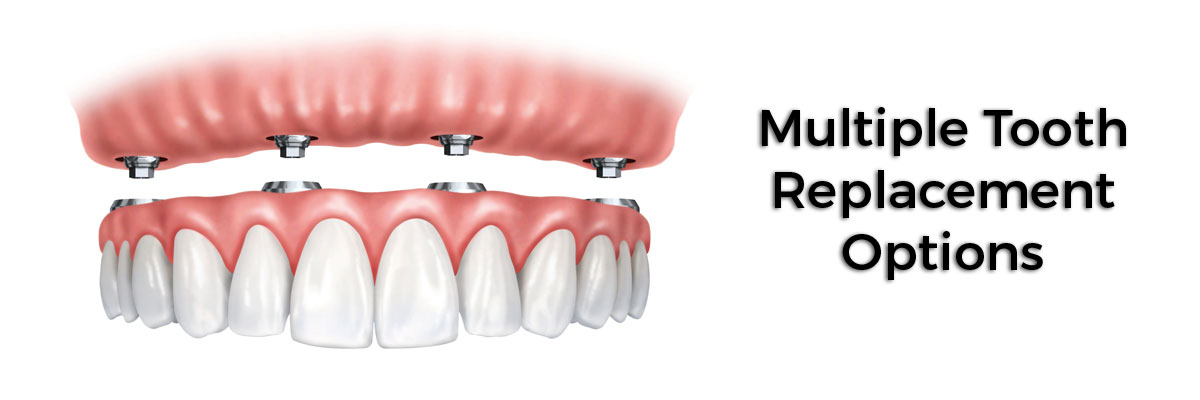 Huntsville Multiple Teeth Replacement Options