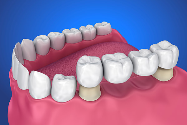 Options for the Replacement of Multiple Missing Teeth from Smiles by Design, PC in Huntsville, AL