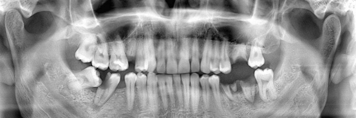 Huntsville Options for Replacing Missing Teeth
