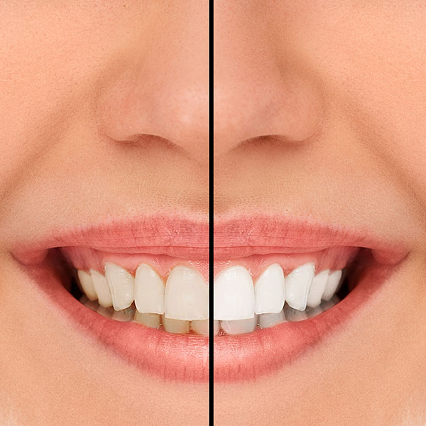 How to Achieve a More Aesthetic Smile: Contouring and Reshaping