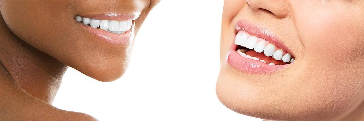 Huntsville Teeth Whitening