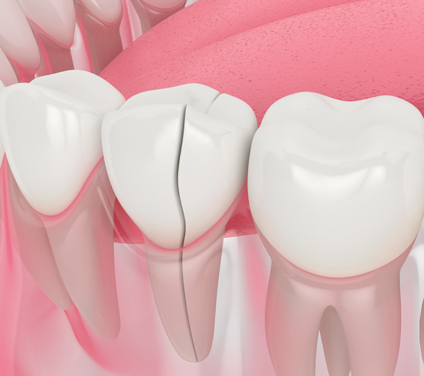 Huntsville Types of Dental Root Fractures