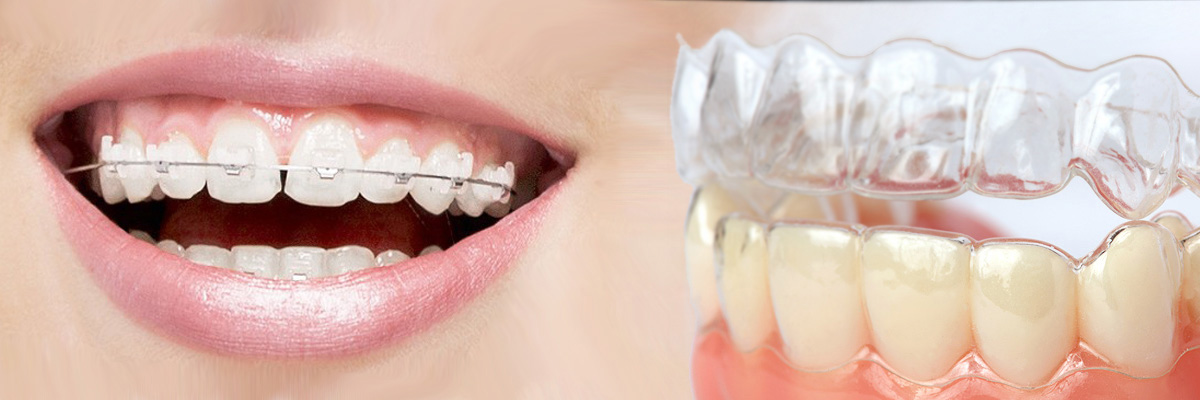 Huntsville Which is Better Invisalign or Braces