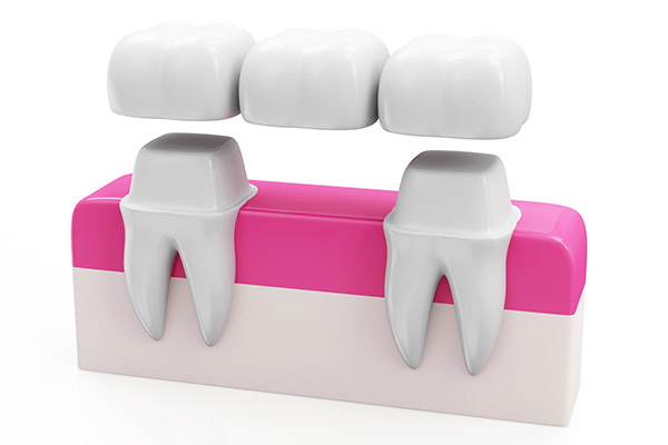 Why Choose a Bridge Option to Replace Missing Teeth from Smiles by Design, PC in Huntsville, AL