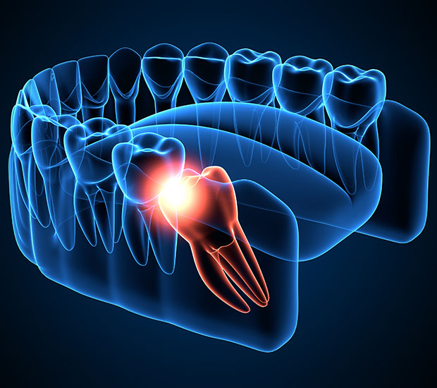 Huntsville Wisdom Teeth Extraction